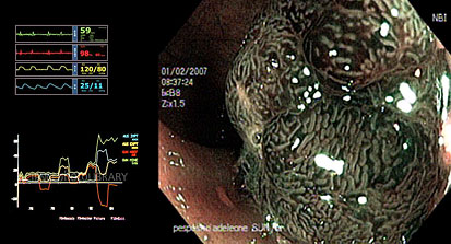 Cromomagnificazione Endoscopica Virtuale
